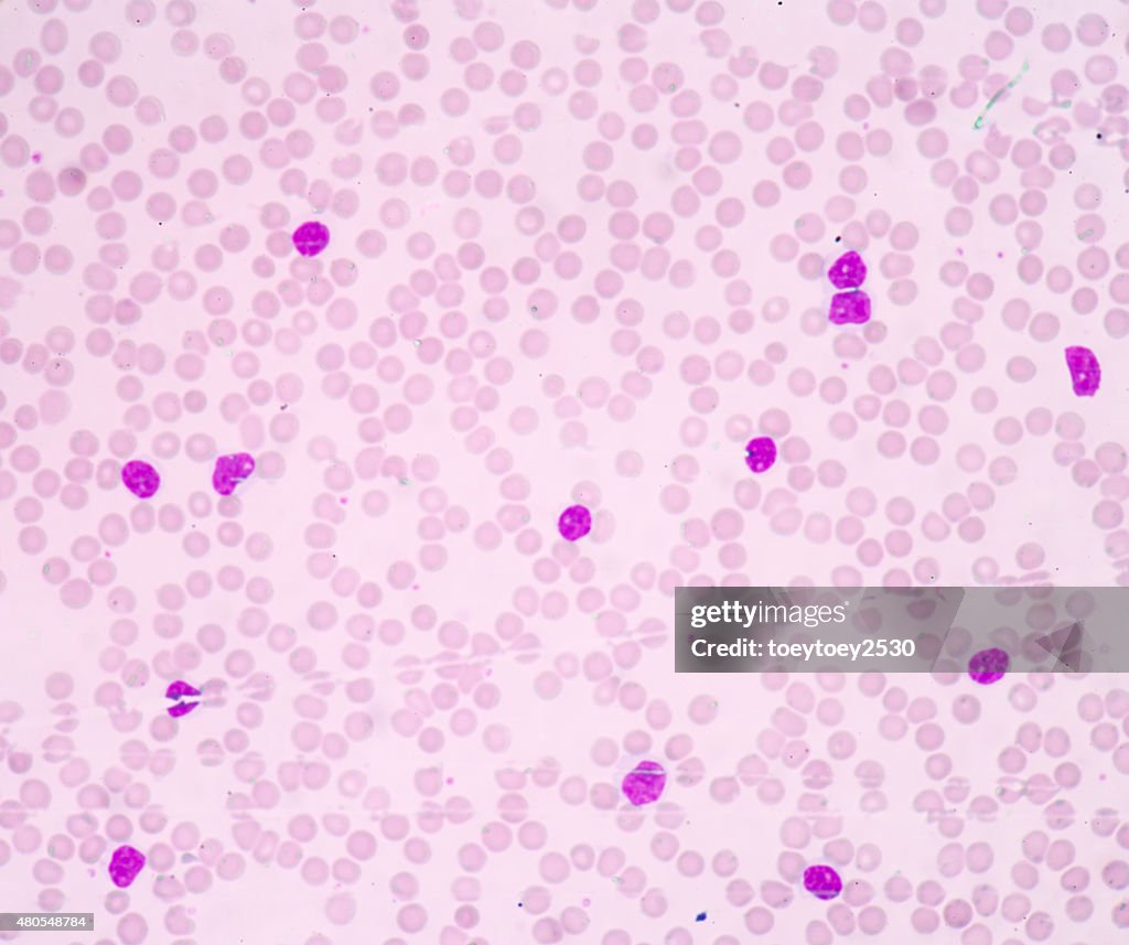 Chronic lymphocytic Leukemia(CLL)