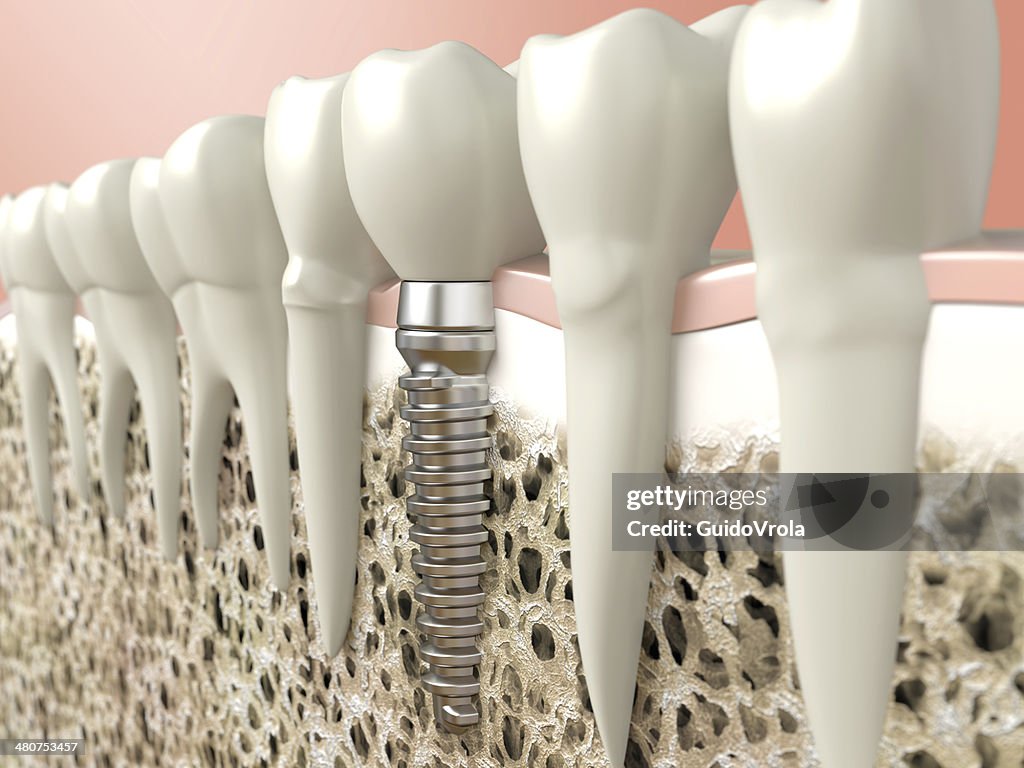 Computer generated image of dental implant
