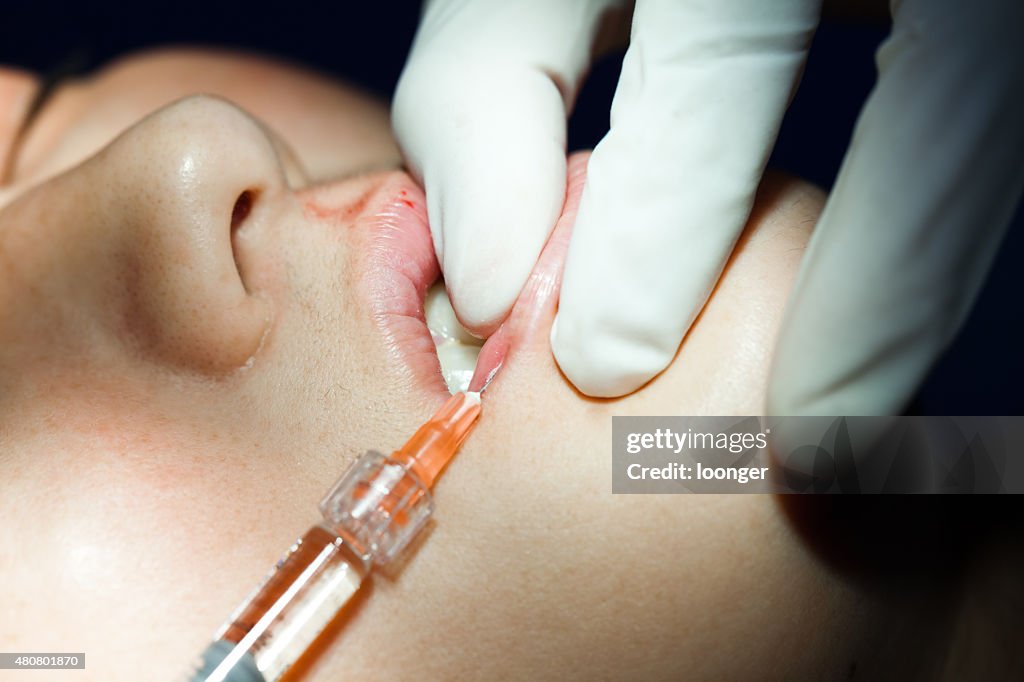 Woman receiving hyaluronic acid injection on her lips