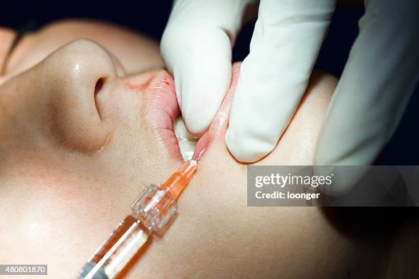 woman receiving hyaluronic acid injection on her lips - lip injections stock pictures, royalty-free photos & images