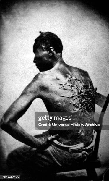 Gordon, also known as "Whipped Peter", a former enslaved man, shows his scarred back at a medical examination, Baton Rouge, Louisiana, 2nd April...