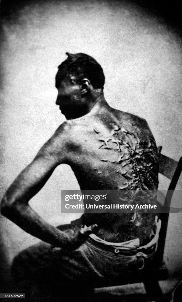 Rear View of Former Enslaved Man Revealing Scars at Medical Inspection