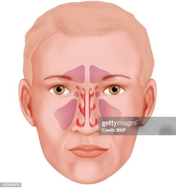 Illustration of the various paranasal sinuses . From top to bottom : frontal sinus , the sphenoid, ethmoidal and maxillary sinuses. Between these...