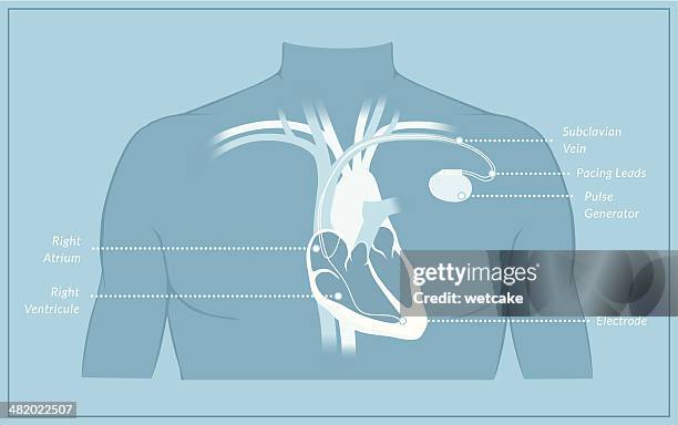 pacemaker diagram with labels - cardiovascular system diagram stock illustrations