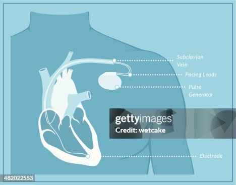 Pacemaker Coloring Pacemaker Blueprint High-Res Vector Graphic - Getty Images