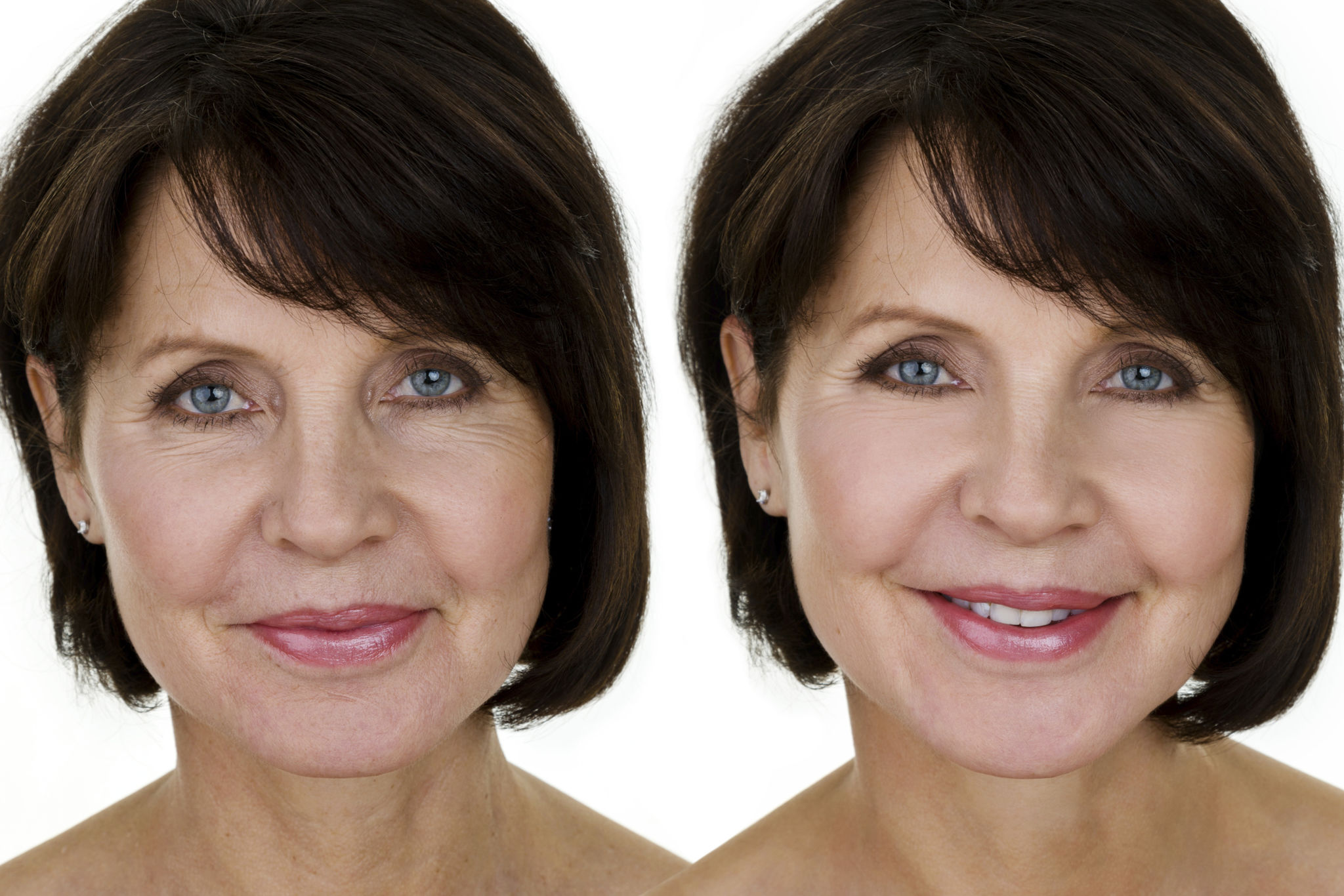 facelift surgery