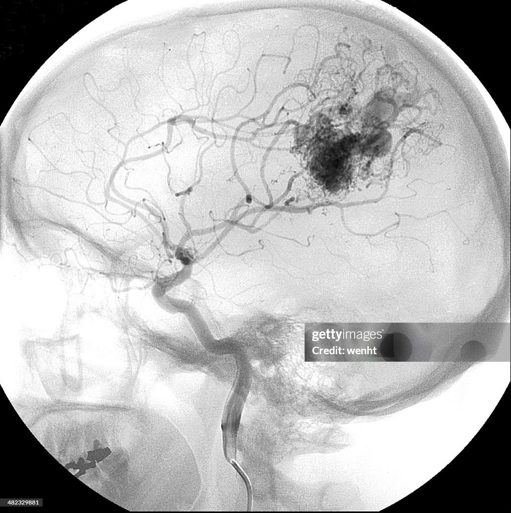 Avm Child Arteriovenous Malformation In The Brain High-Res Stock Photo - Getty Images