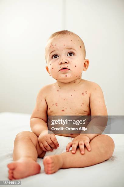 33 Baby Chicken Pox Stock Photos, High-Res Pictures, and Images - Getty