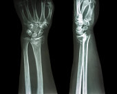 fracture distal radius (Colles' fracture) (wrist broken)