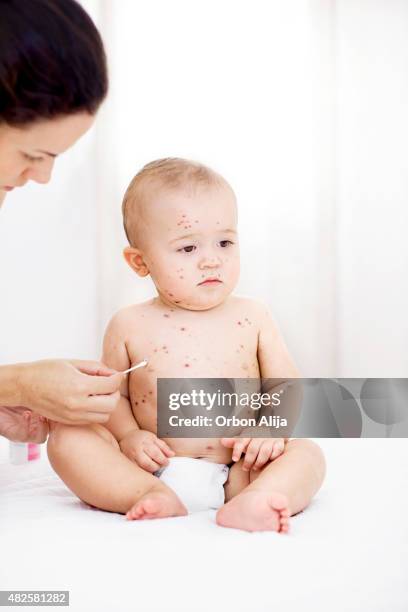 baby with chicken pox - chickenpox 個照片及圖片檔