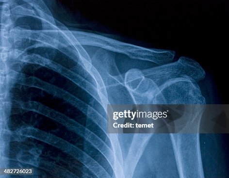 X-ray image der Schulter X-ray image der Schulter