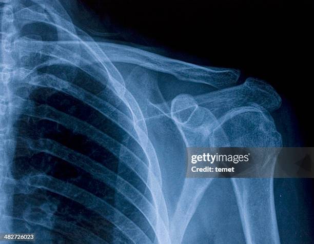 x-ray image der schulter - röntgen stock-fotos und bilder