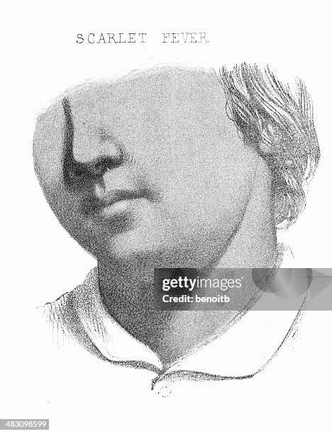 scarlet fever - scarlet fever stock illustrations