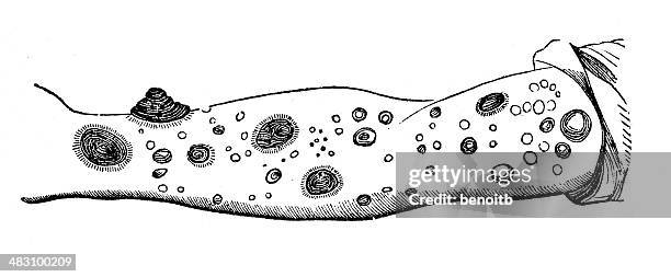 Scab Vector 91 Skin Scab Stock Photos, High-Res Pictures, and Images - Getty Images