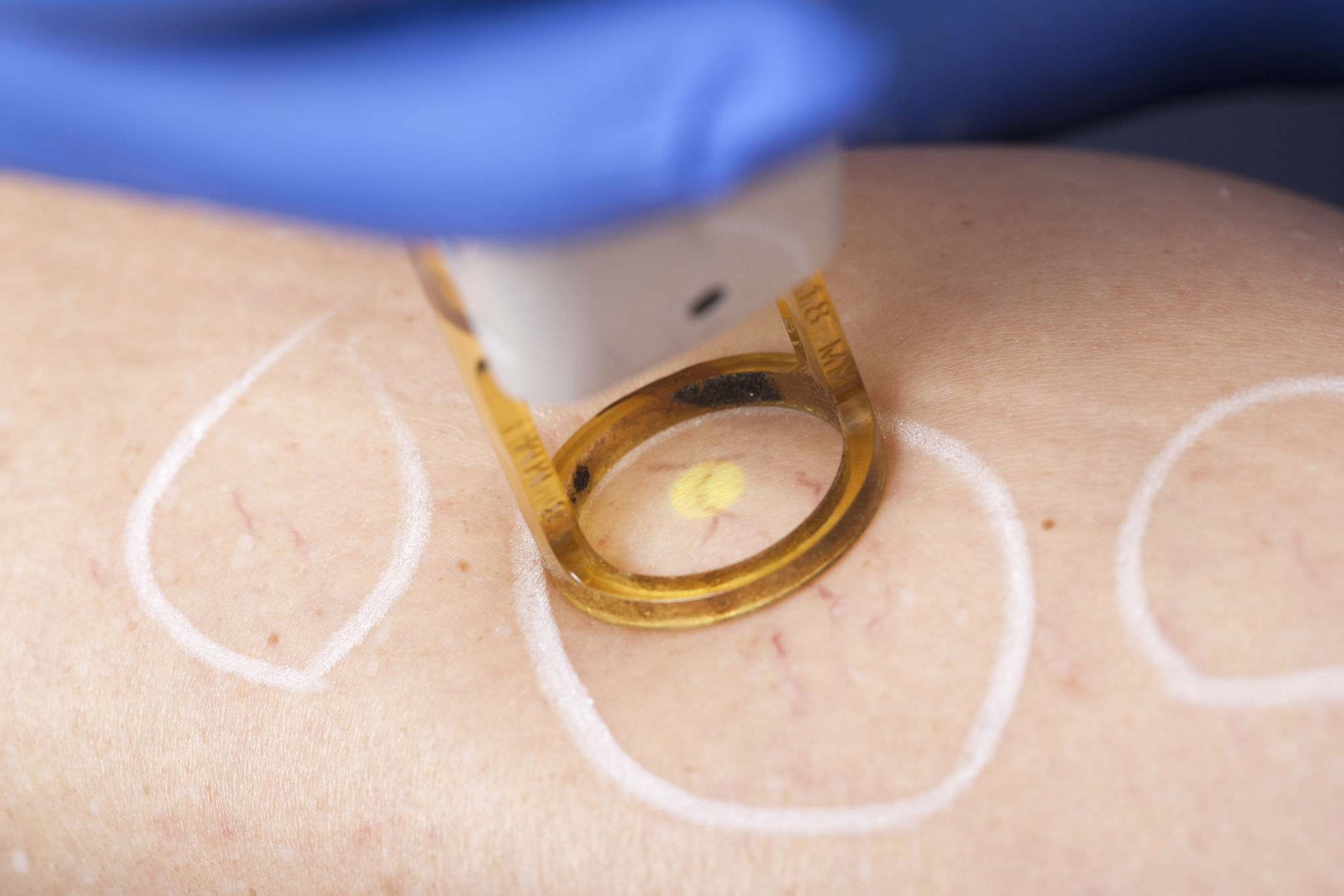 laser treatment varicose veins