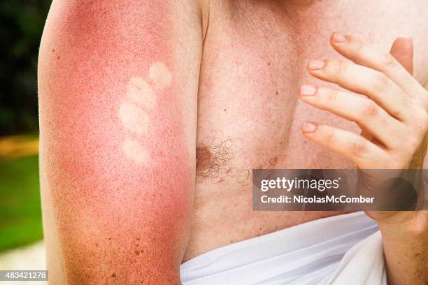 dolor quemaduras de sol marca en la parte superior del brazo, macho - quemado por el sol fotografías e imágenes de stock