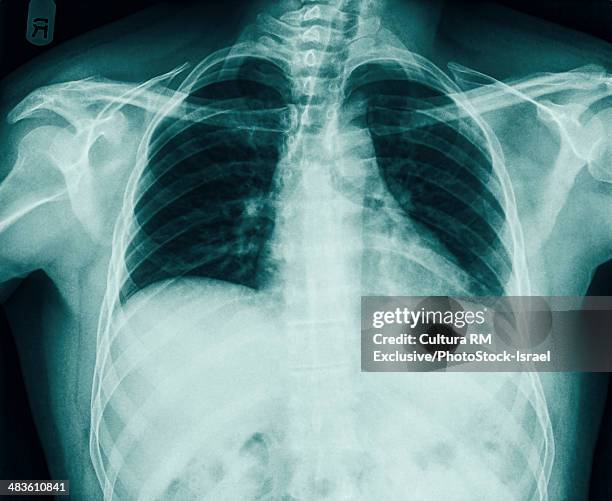 fracture of the number 10 rib can be seen in a chest x-ray of a 36 year old male. front view - rib cage stock-fotos und bilder