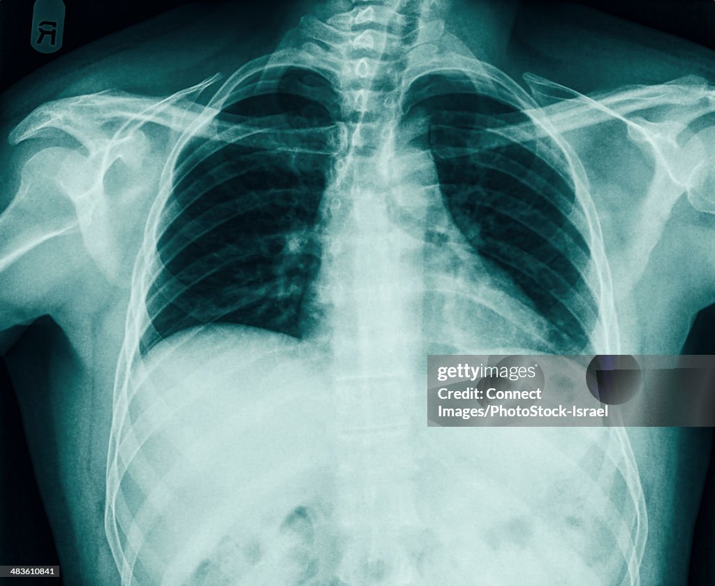 10 In Rib Fracture Of The Number 10 Rib Can Be Seen In A Chest Xray Of A 36 Year ...
