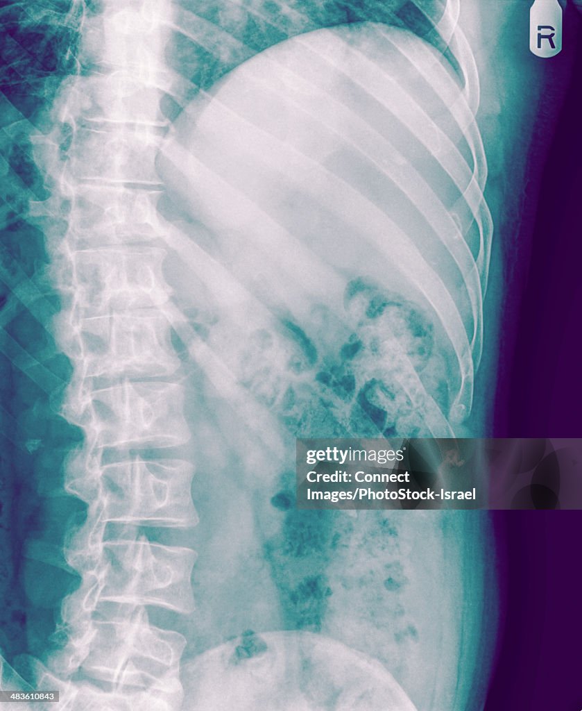 Fracture of the number 10 rib can be seen in a Chest x-ray of a 36 year old male. front view