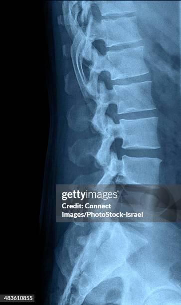 human lumbar spine x-ray side view - columna vertebral fotografías e imágenes de stock