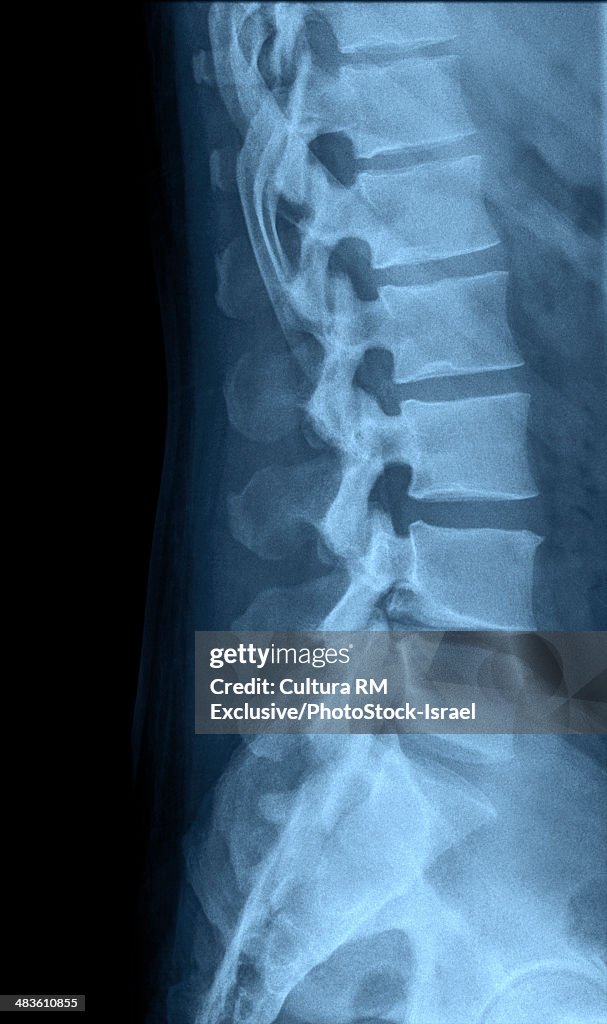 Human Lumbar Spine X-Ray side view