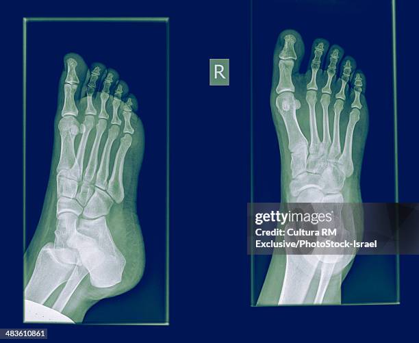 x-ray of a foot showing a fracture in the proximal phalanx of the big toe on the right foot of a 30 year old female patient - broken heel stock-fotos und bilder