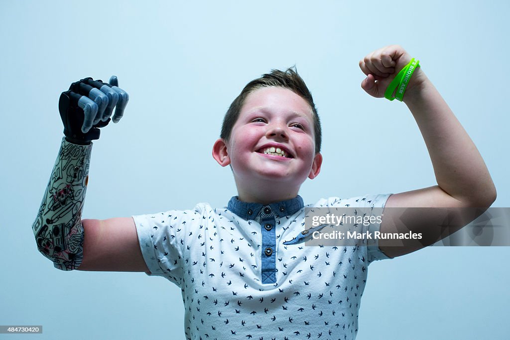 Nine Year Old Boy Is Fitted With A Bionic Arm