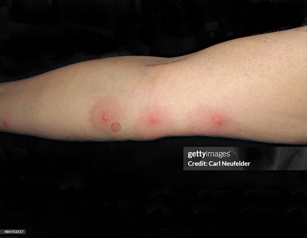 Bed Bug Bite Blisters