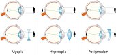 Visual Defects - Myopia, Hyperopia And Astigmatism