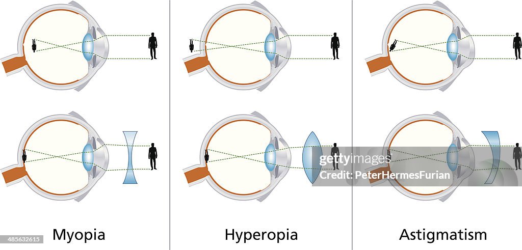Defects In Vision Visual Defects Myopia Hyperopia And Astigmatism High-Res Vector Graphic ...