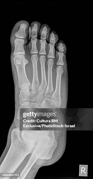 x-ray of a foot showing a fracture in the 5th metatarsalia of a 31 year old male - broken heel photos et images de collection