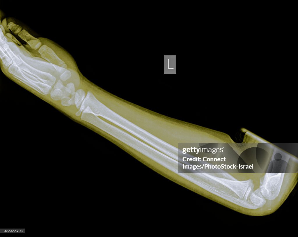 Forearm of a 9 year old male patient with a Distal Radius Fracture