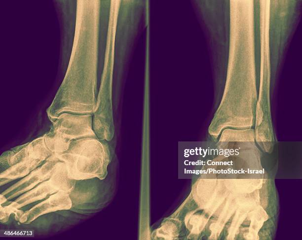 Tibia Distal View Distal Tibia Photos and Premium High Res Pictures - Getty Images