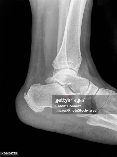 Tibia Distal View Distal Tibia Photos and Premium High Res Pictures - Getty Images