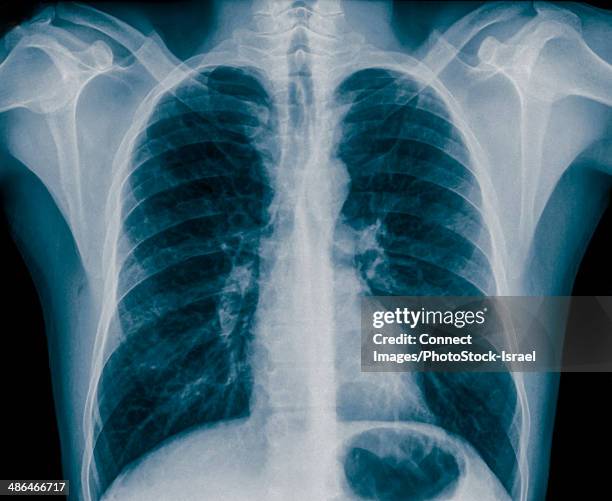x-ray of normal healthy chest front view, 36 year old male - rayos x fotografías e imágenes de stock