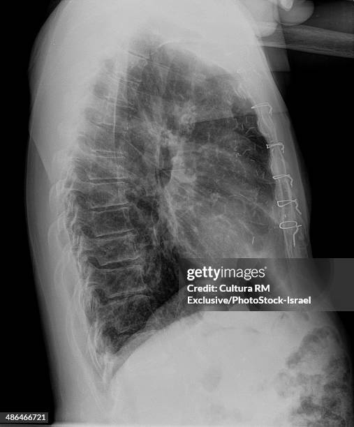 x-ray of patient with pneumonia after sternotomy surgery side view, 72 year old male - 70 year male stock-fotos und bilder