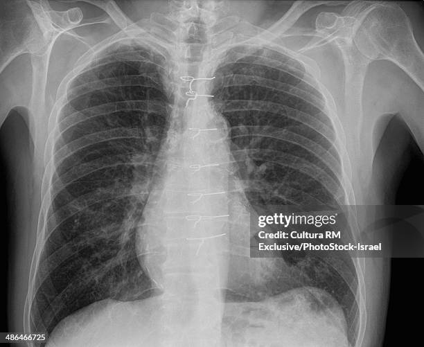 x-ray of patient with pneumonia after sternotomy surgery front view, 72 year old male - 70 year male stock-fotos und bilder