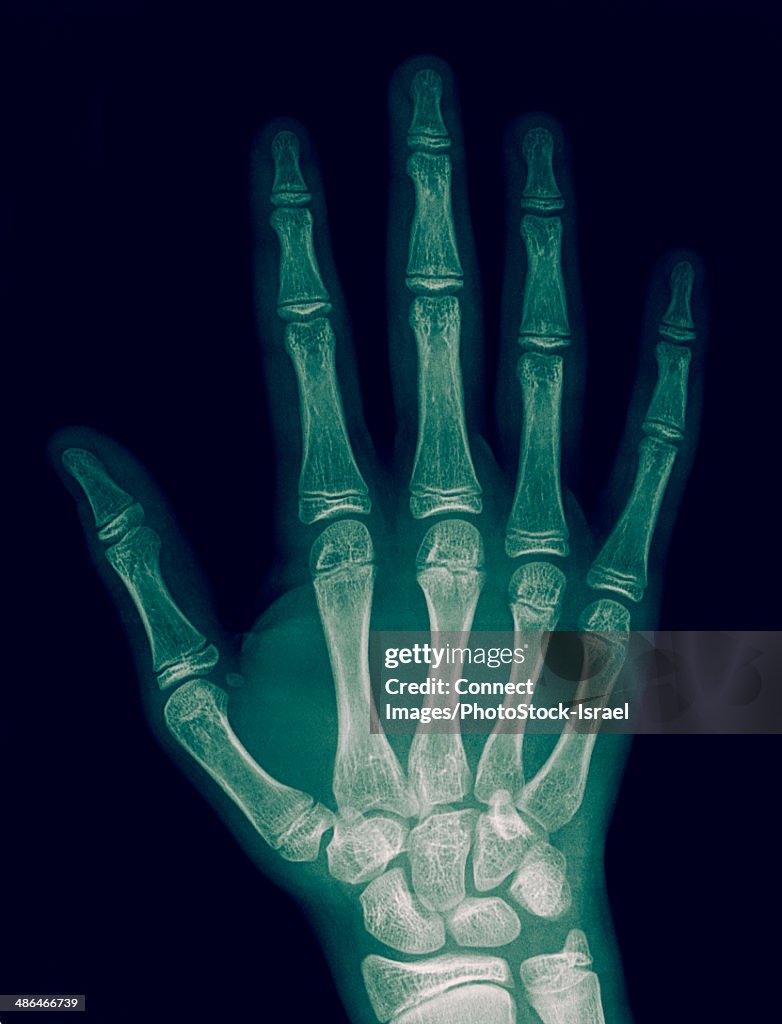 X-ray of right hand with fracture in the number 3 metacarpal bone, 14 year old male