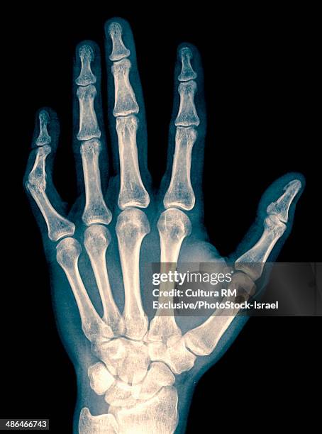 x-ray of wrist, hand and fingers with dislocated left thumb due to contusion, 34 year old male - bruised finger stock-fotos und bilder