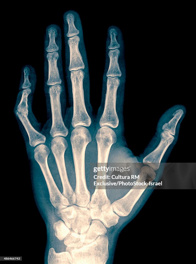 X-ray of wrist, hand and fingers with dislocated left thumb due to contusion, 34 year old male