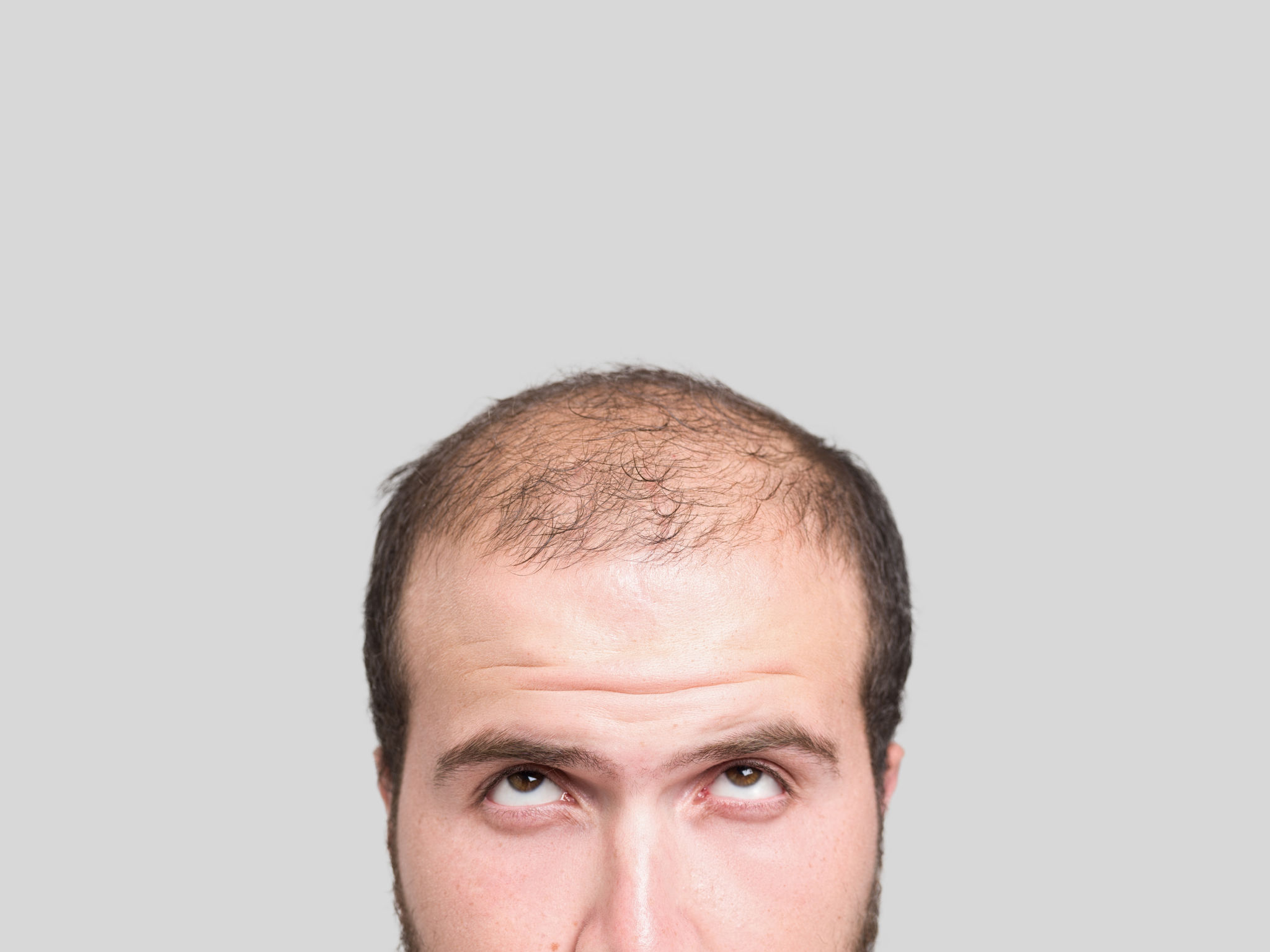 Bald young man, front view Bald young man, front view