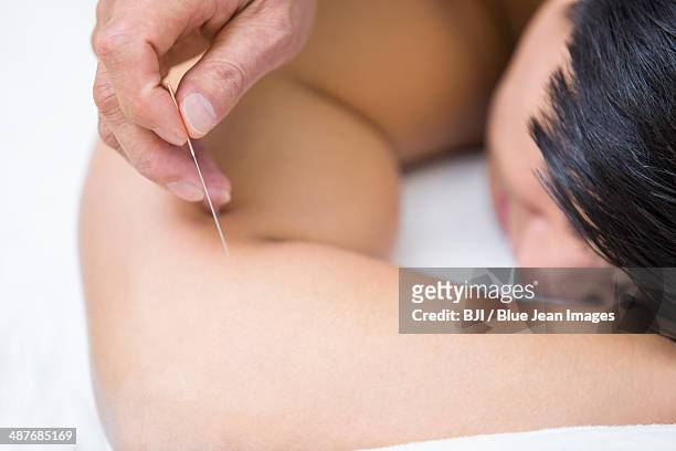 patient receiving acupuncture - acupuncture elderly stock pictures, royalty-free photos & images