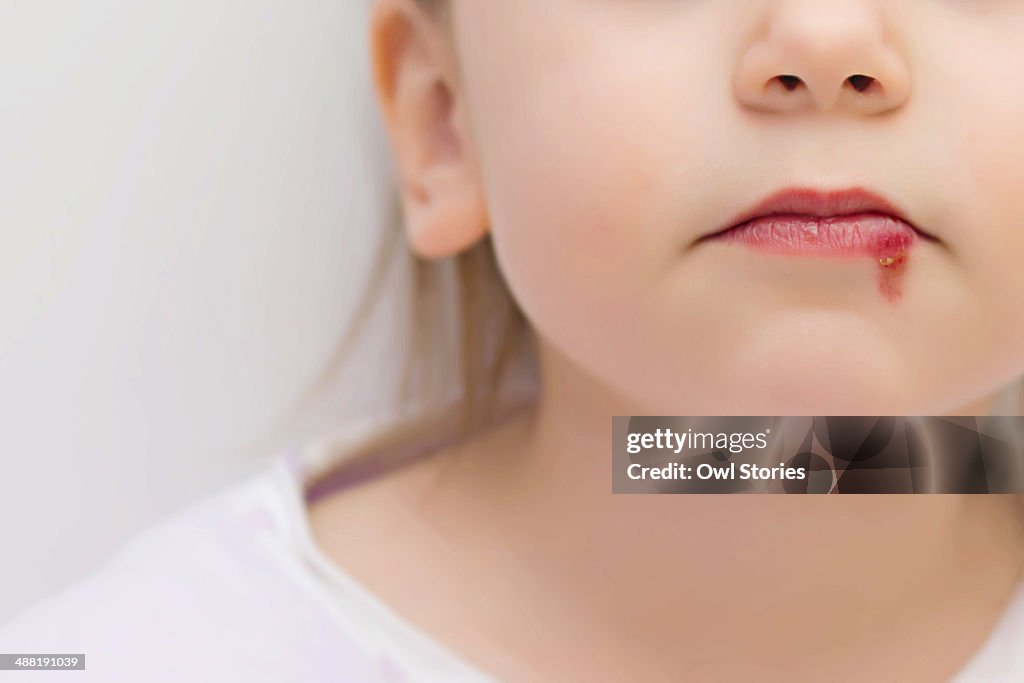 Young girl with wound on the lower lip