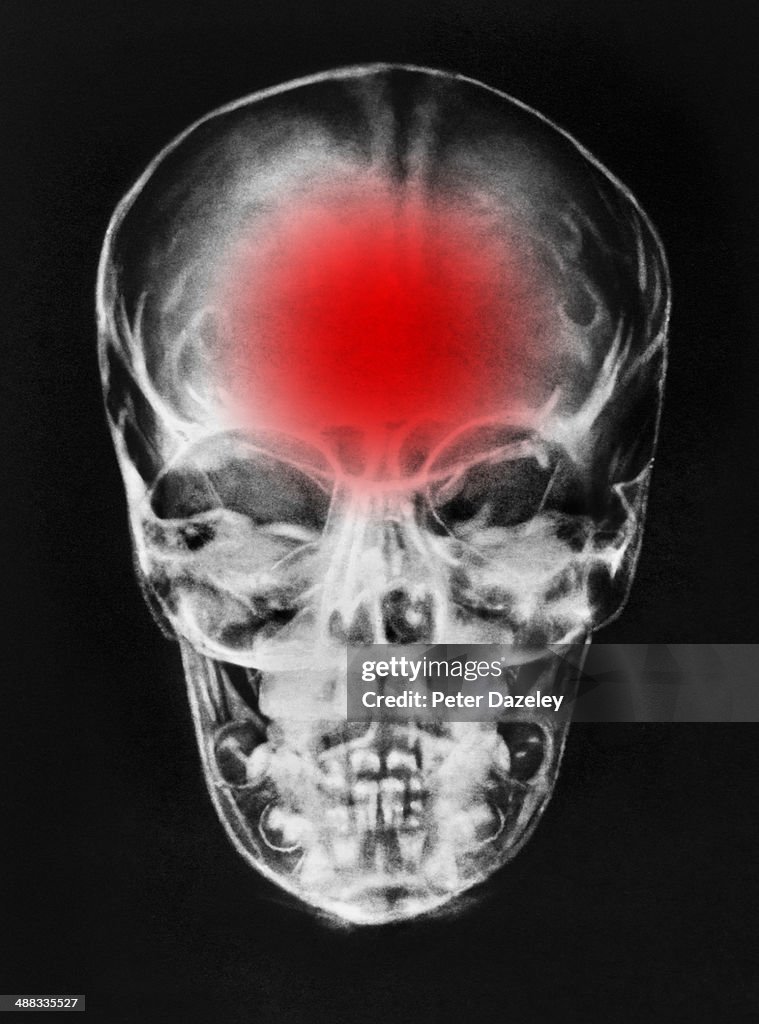 Brain damage/tumour/ headache