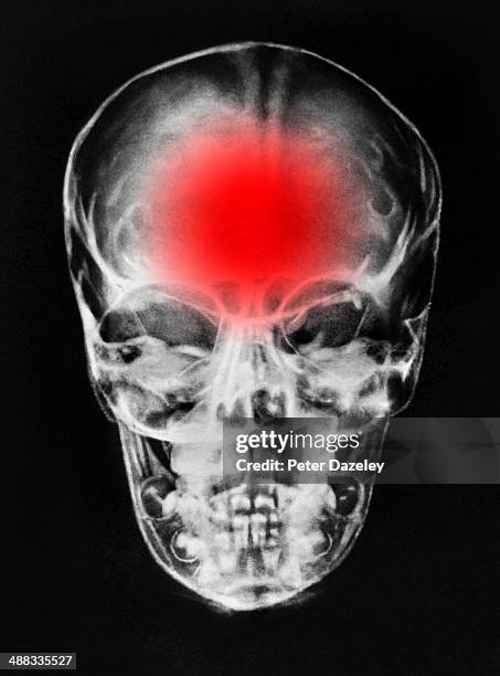 brain damage/tumour/ headache - head injury foto e immagini stock