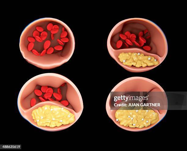 atherosclerosis, artwork - atherosklerose stock-grafiken, -clipart, -cartoons und -symbole