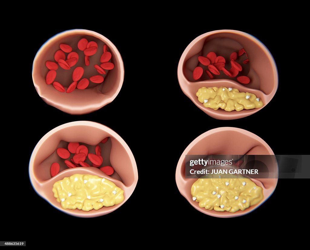Atherosclerosis, artwork