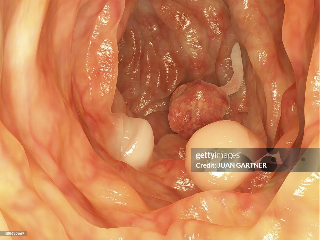 Polyps in colon, artwork
