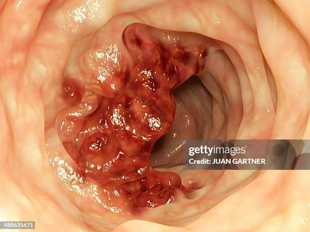 intestinal tumor, artwork - bowel cancer stock illustrations