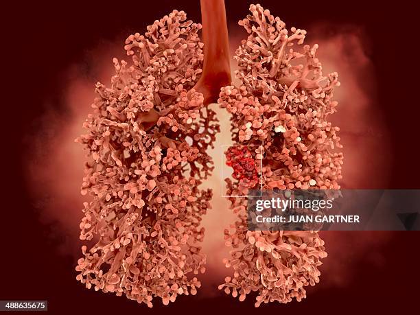 lung cancer, artwork - lungenkrebs stock-grafiken, -clipart, -cartoons und -symbole